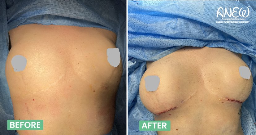 mommy makeover surgery cost